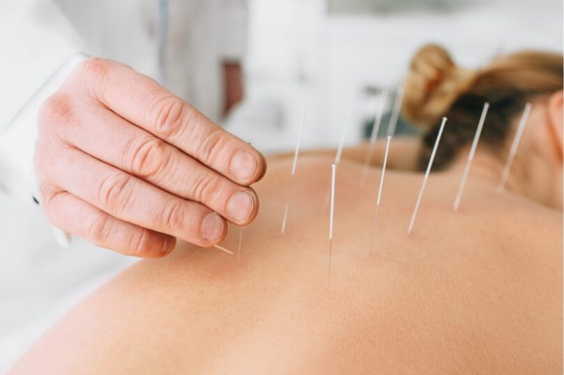 Dry-Needling Dry-Needling