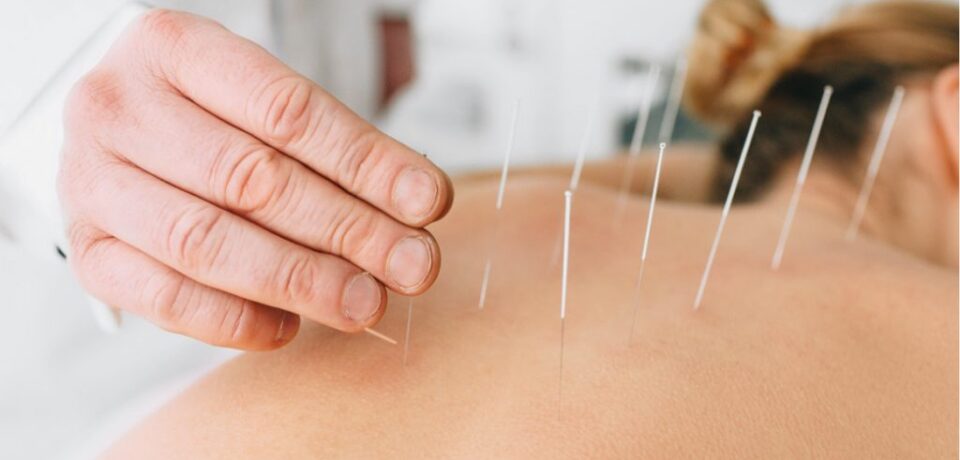 Dry-Needling