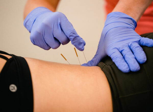 Dry-Needling-back-1920x1280