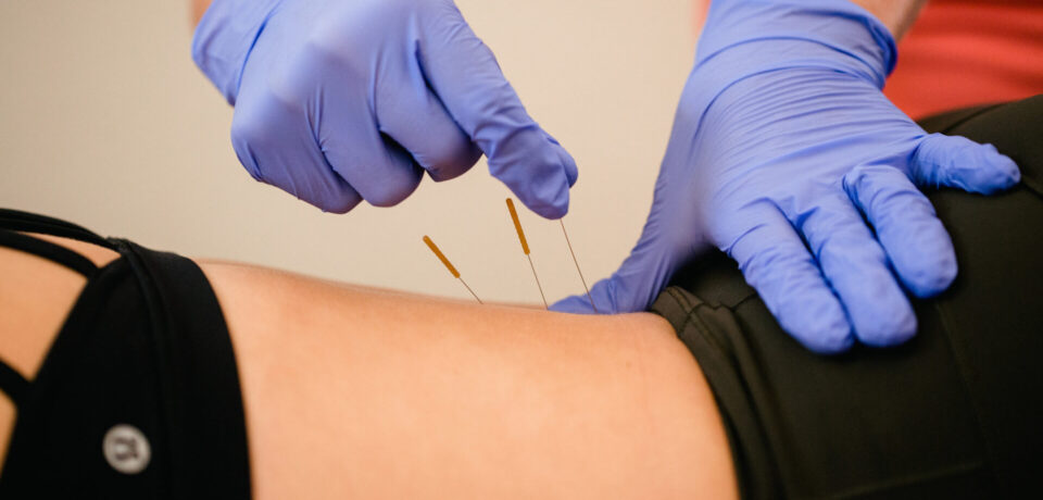 Dry-Needling-back-1920x1280