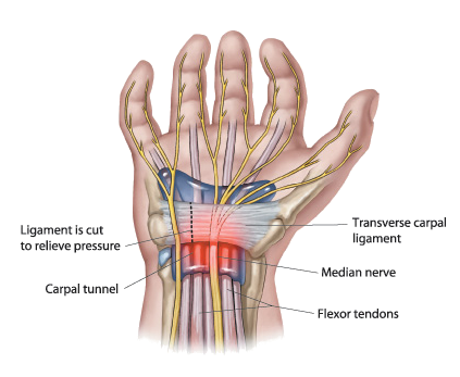 carpal_syndrom-1