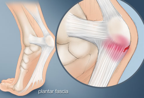 plantar_fascia