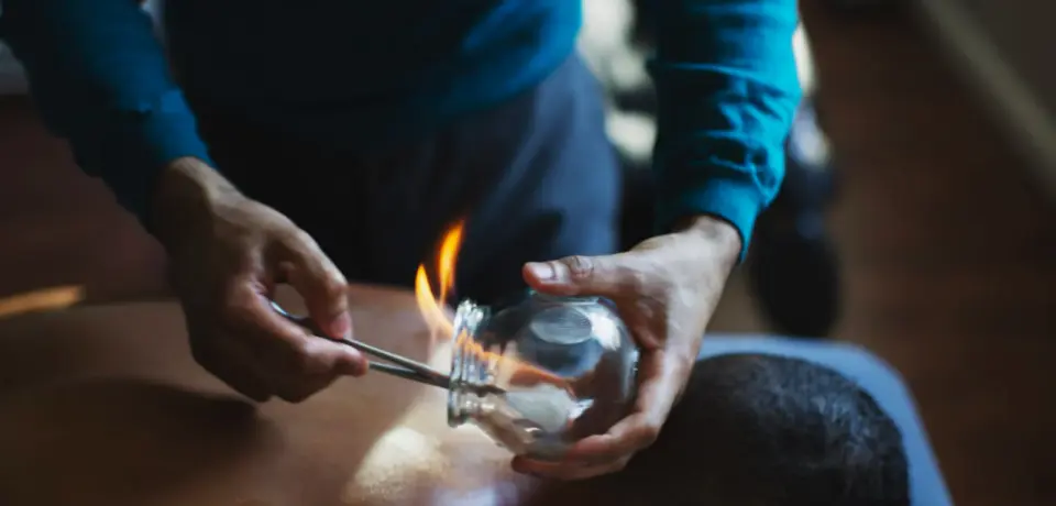 Fire-Cupping-2 Fire-Cupping-2