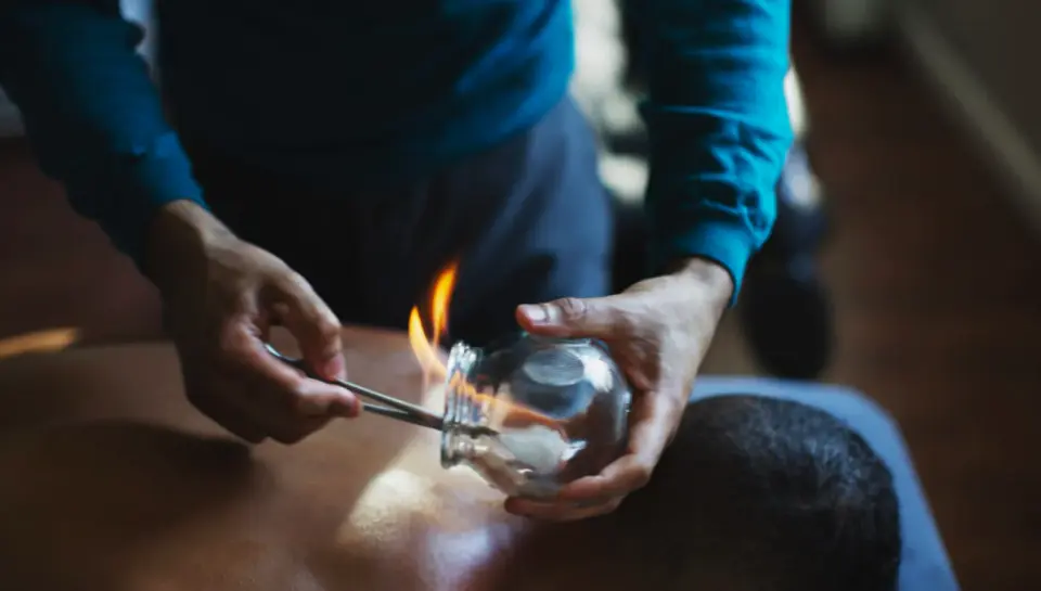 Fire-Cupping-2