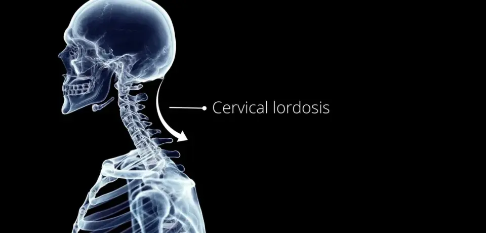 cervical_lordosis-stjosephsphysio.com cervical_lordosis-stjosephsphysio.com