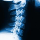 cervical lordosis cervical lordosis