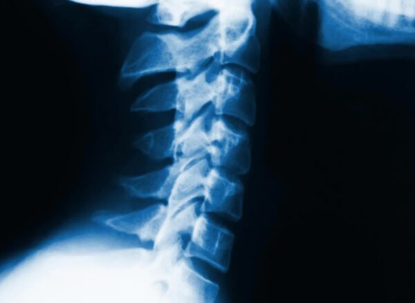 cervical lordosis cervical lordosis