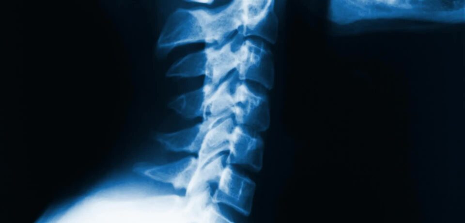 cervical lordosis cervical lordosis