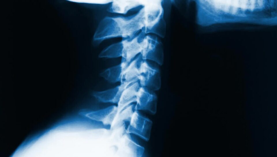 cervical lordosis cervical lordosis