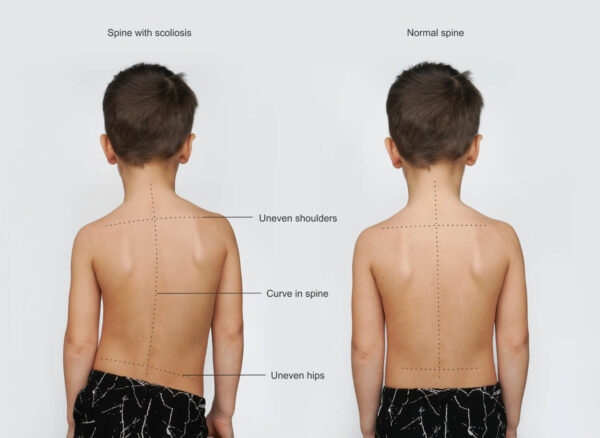 skolioza skolioza