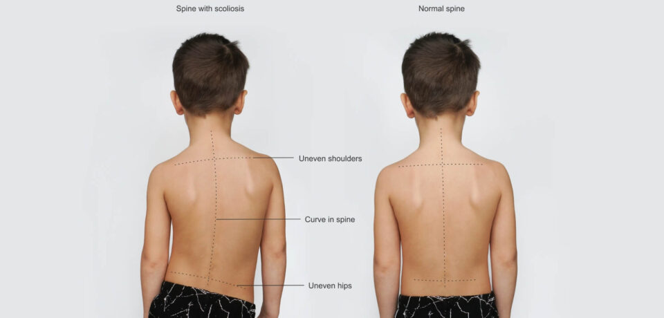 skolioza