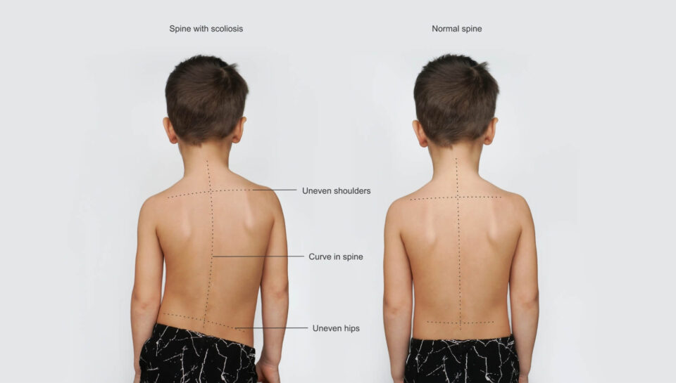 skolioza