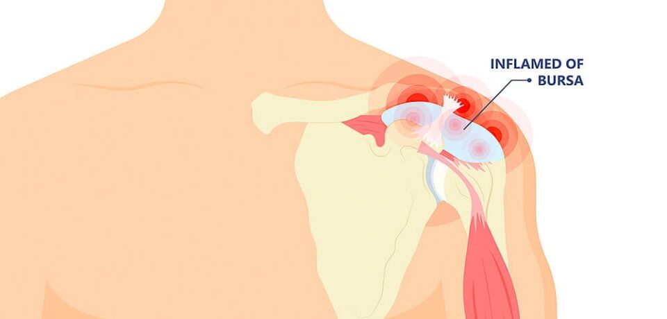 Shoulder-bursitis