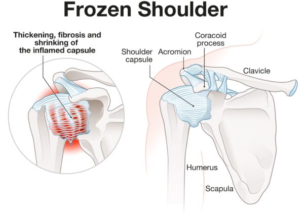 Frozen-Shoulder-Anatomy-2048x1511