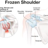 Frozen-Shoulder-Anatomy-2048x1511