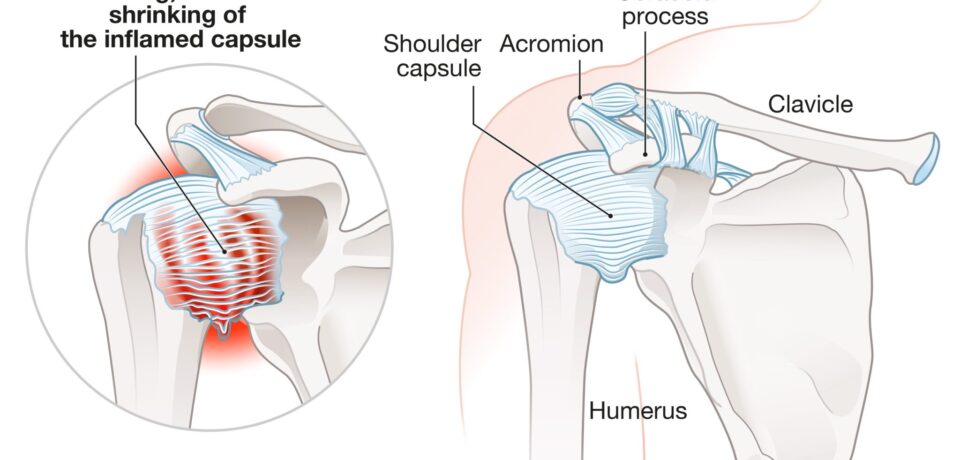 Frozen-Shoulder-Anatomy-2048x1511