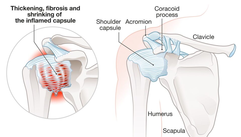 Frozen-Shoulder-Anatomy-2048x1511