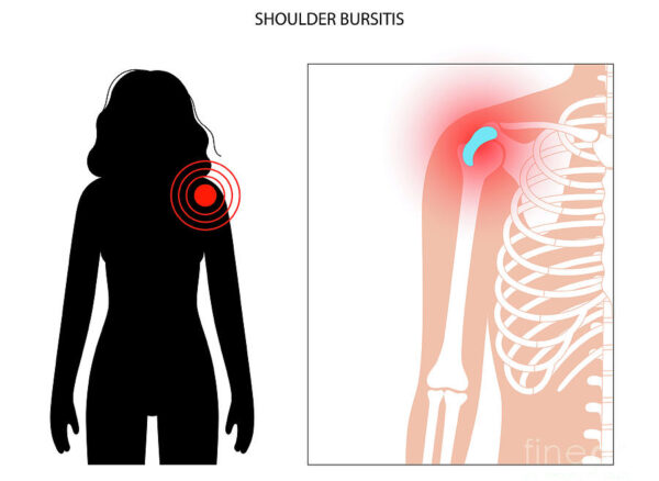 7-shoulder-bursitis-pikovit-science-photo-library