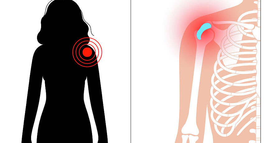 7-shoulder-bursitis-pikovit-science-photo-library