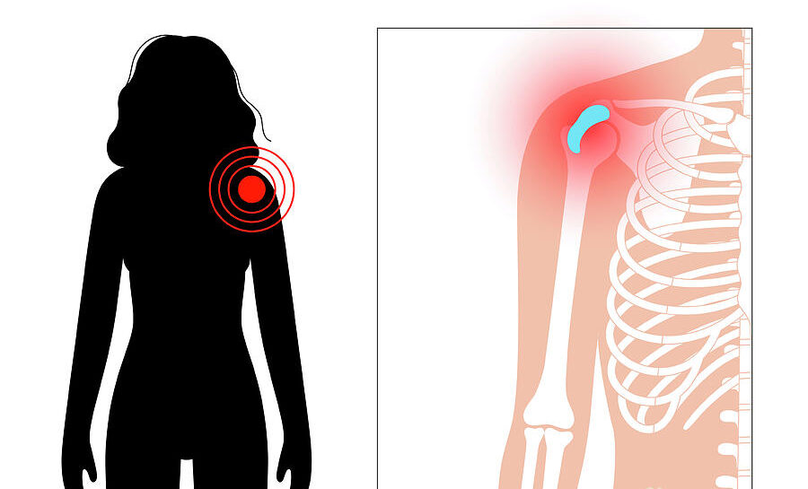 7-shoulder-bursitis-pikovit-science-photo-library