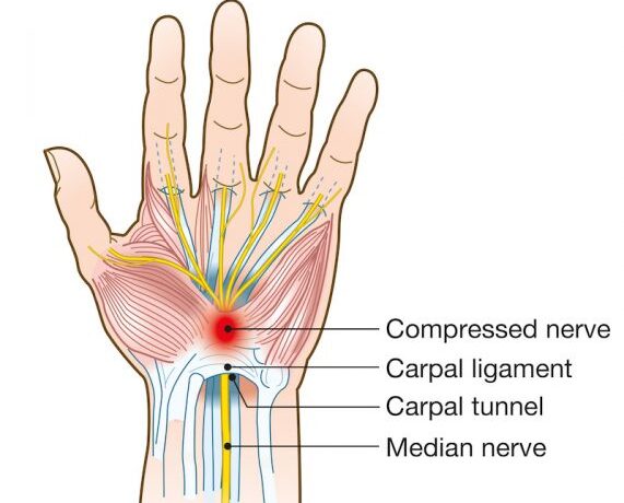 Carpal-tunnel-571x600
