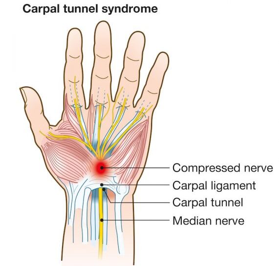 Carpal-tunnel-571x600