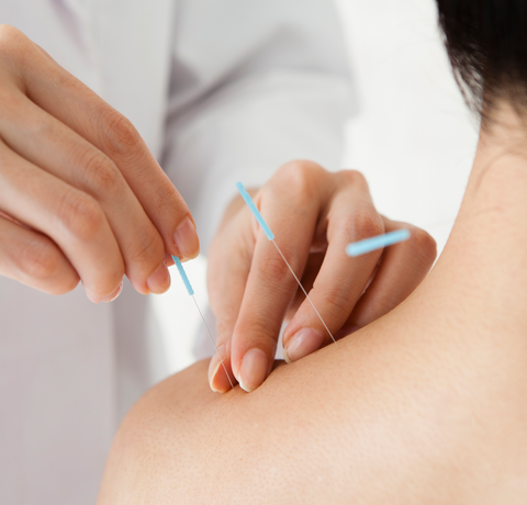 DRY-NEEDLING-FOTO