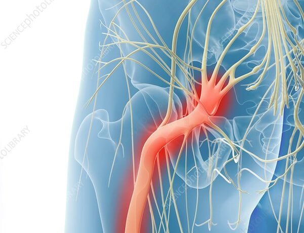 Inflamed sciatic nerve, computer artwork.