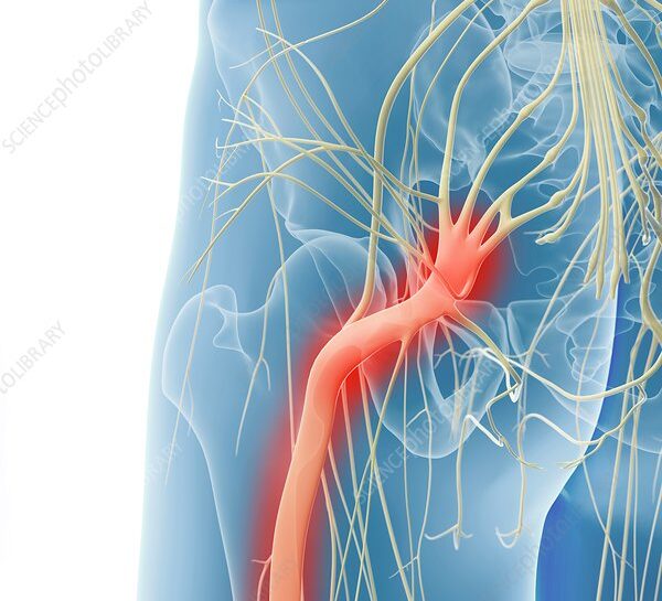 Inflamed sciatic nerve, computer artwork.