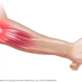 ds00469_im00373_mcdc7_tennis_elbow_jpg