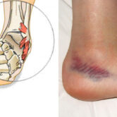 immagini-distorsione-caviglia