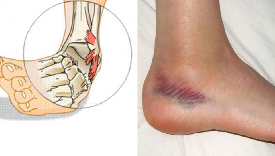 immagini-distorsione-caviglia